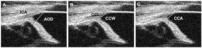 Evaluation of ciliary cleft changes after phacoemulsification using ultrasound biomicroscopy in dogs with cataracts